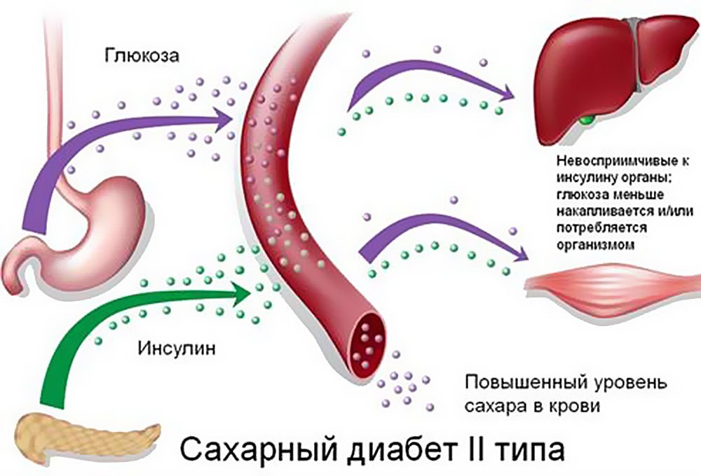 Кишечные бактерии влияют на заболеваемость сахарным диабетом 2 типа